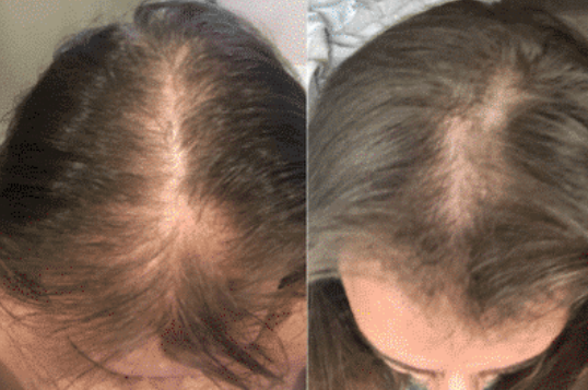 Red Light Therapy for Hair Growth: Everything You Need to Know